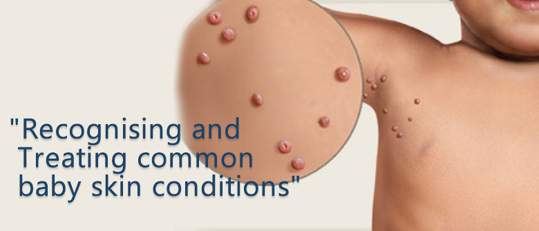 Recognising and Treating common baby skin conditions